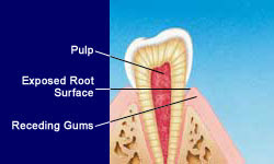 Tooth Sensitivity